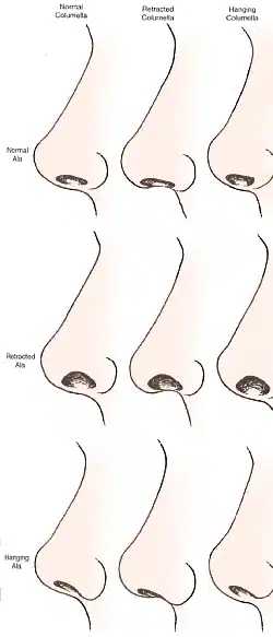 Figure 11 Rhinoplasty