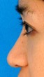 After Image Ethnic Rhinoplasty Before & After New Jersey