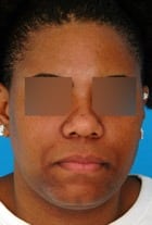 Before Image Ethnic Rhinoplasty Before & After New Jersey