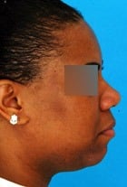 Before Image Asian Rhinoplasty Before & After New Jersey