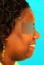 Before Image Asian Rhinoplasty Before & After New Jersey