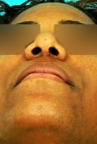 Before Image Asian Rhinoplasty Before & After New Jersey