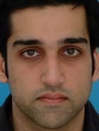 Before Image Asian Rhinoplasty Before & After New Jersey