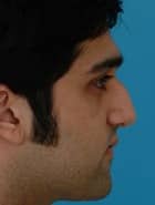 Before Image Asian Rhinoplasty Before & After New Jersey