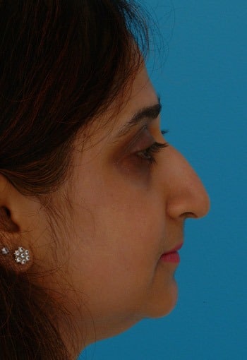 Before Image Asian Rhinoplasty Before & After New Jersey