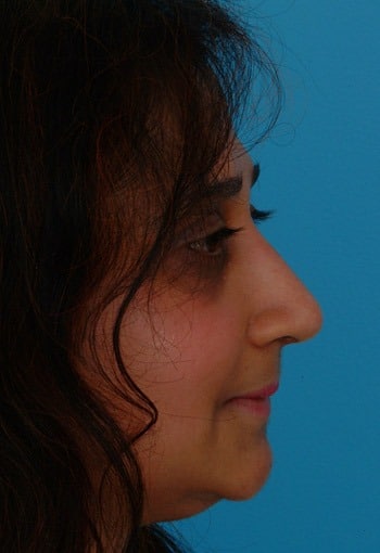 Before Image Asian Rhinoplasty Before & After New Jersey
