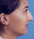 Before Image Asian Rhinoplasty Before & After New Jersey
