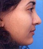 Before Image Asian Rhinoplasty Before & After New Jersey