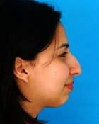 Before Image Asian Rhinoplasty Before & After New Jersey