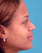 Before Image Asian Rhinoplasty Before & After New Jersey