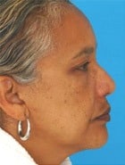 Before Image Asian Rhinoplasty Before & After New Jersey