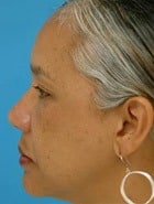 Before Image Asian Rhinoplasty Before & After New Jersey