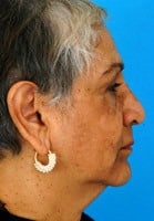 Before Image Asian Rhinoplasty Before & After New Jersey