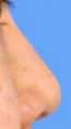 Before Image Asian Rhinoplasty Before & After New Jersey