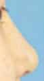Before Image Asian Rhinoplasty Before & After New Jersey